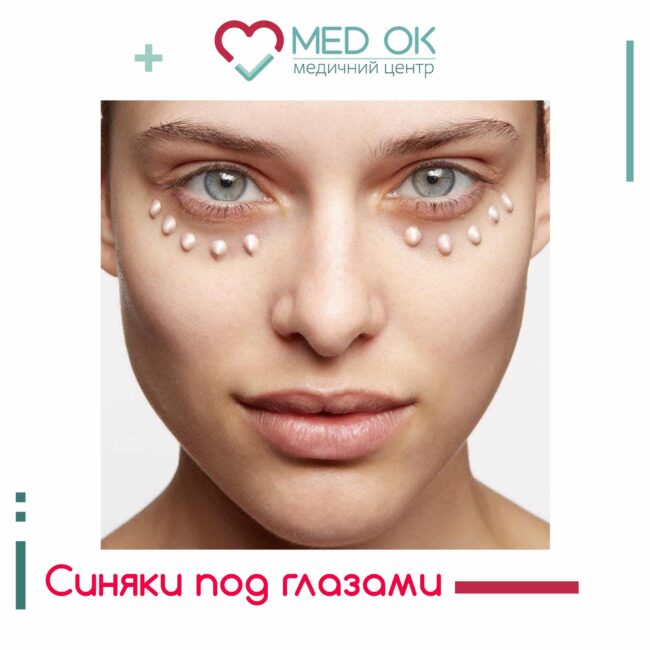 Синяки под глазами