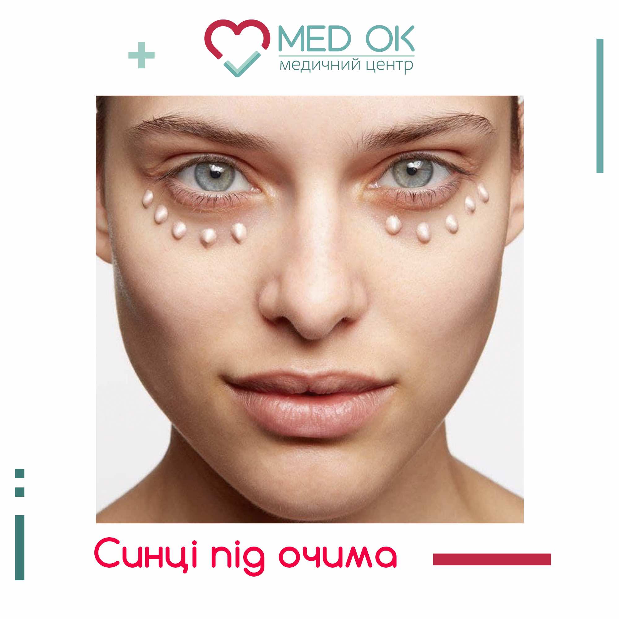 Плями під очима